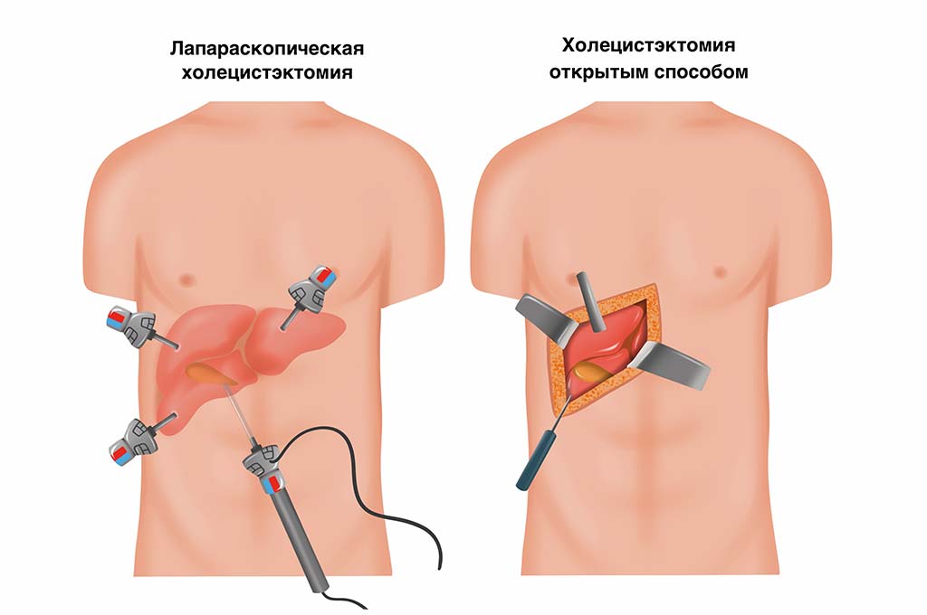 udalenie-zhelchnogo-puzyrya.jpg