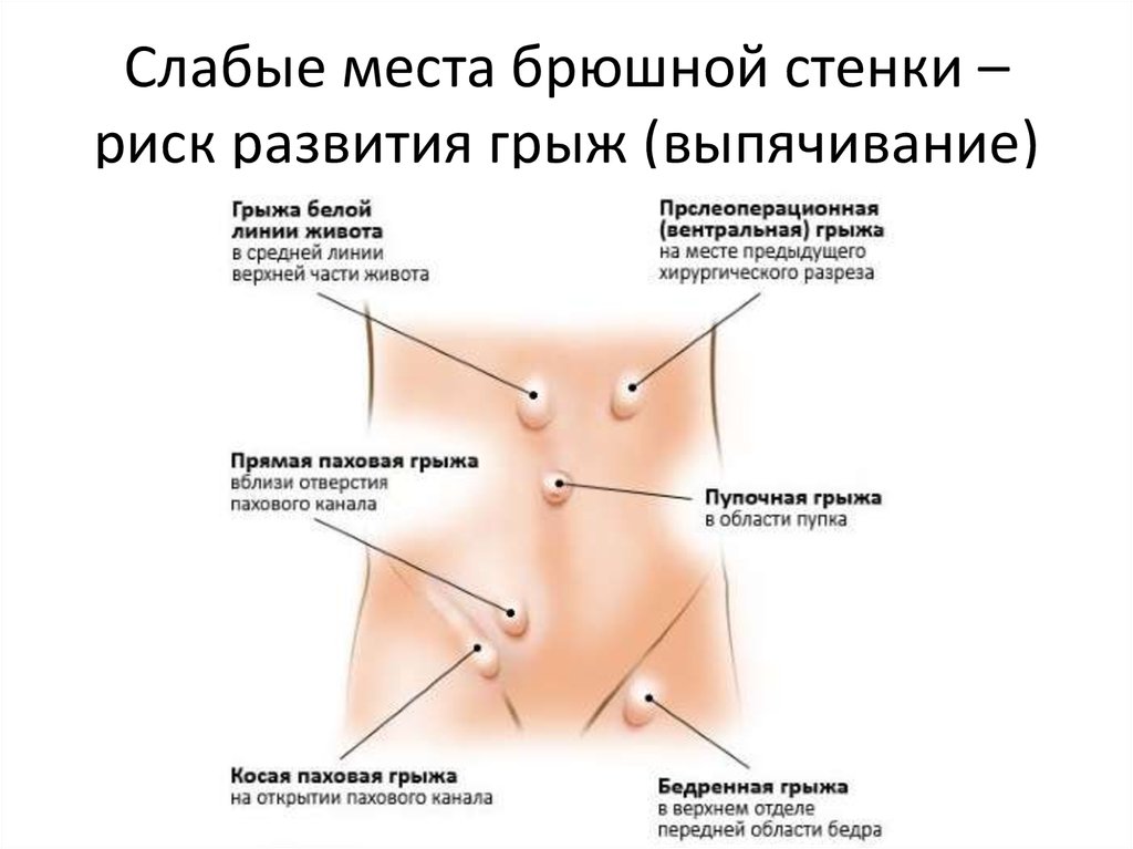 Слабые места брюшной стенки - риск развития грыж
