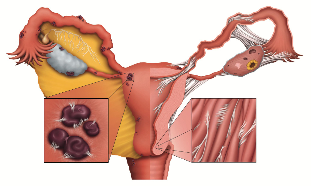 эндометриоз_1.jpg